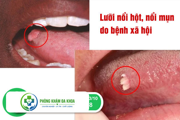 Lưỡi nổi hột do viêm gai lưỡi gây ra luoi noi hot la dau hieu cua benh gi