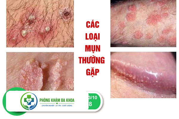 Các triệu chứng đáng lưu ý khi mắc phải mụn sinh dục