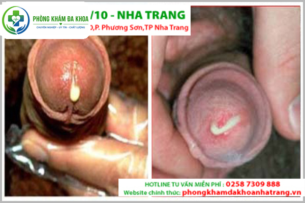 Tình trạng tiểu buốt rắt và ra mủ cảnh báo bệnh lậu