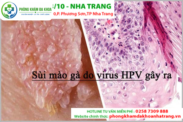 Định nghĩa đúng về sùi mào gà