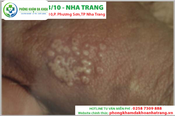 Bệnh mụn rộp sinh dục: