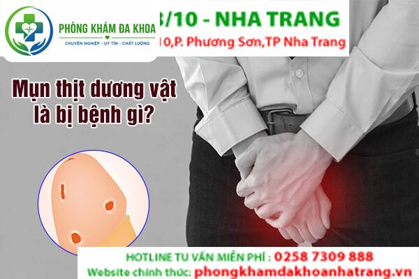  Mụn thịt ở dương vật là dấu hiệu sùi mào gà