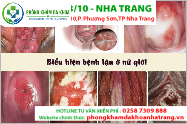 Những hình ảnh của bệnh lậu ở nữ giới