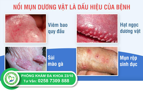 Nguyên nhân nổi mụn trắng ở rãnh bao quy đầu là gì?